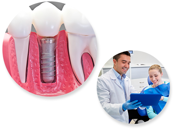 Implantes Dentários