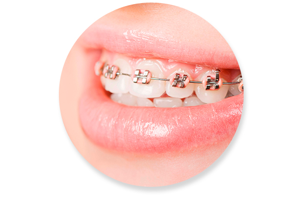 Tratamento de Aparelho Ortodôntico